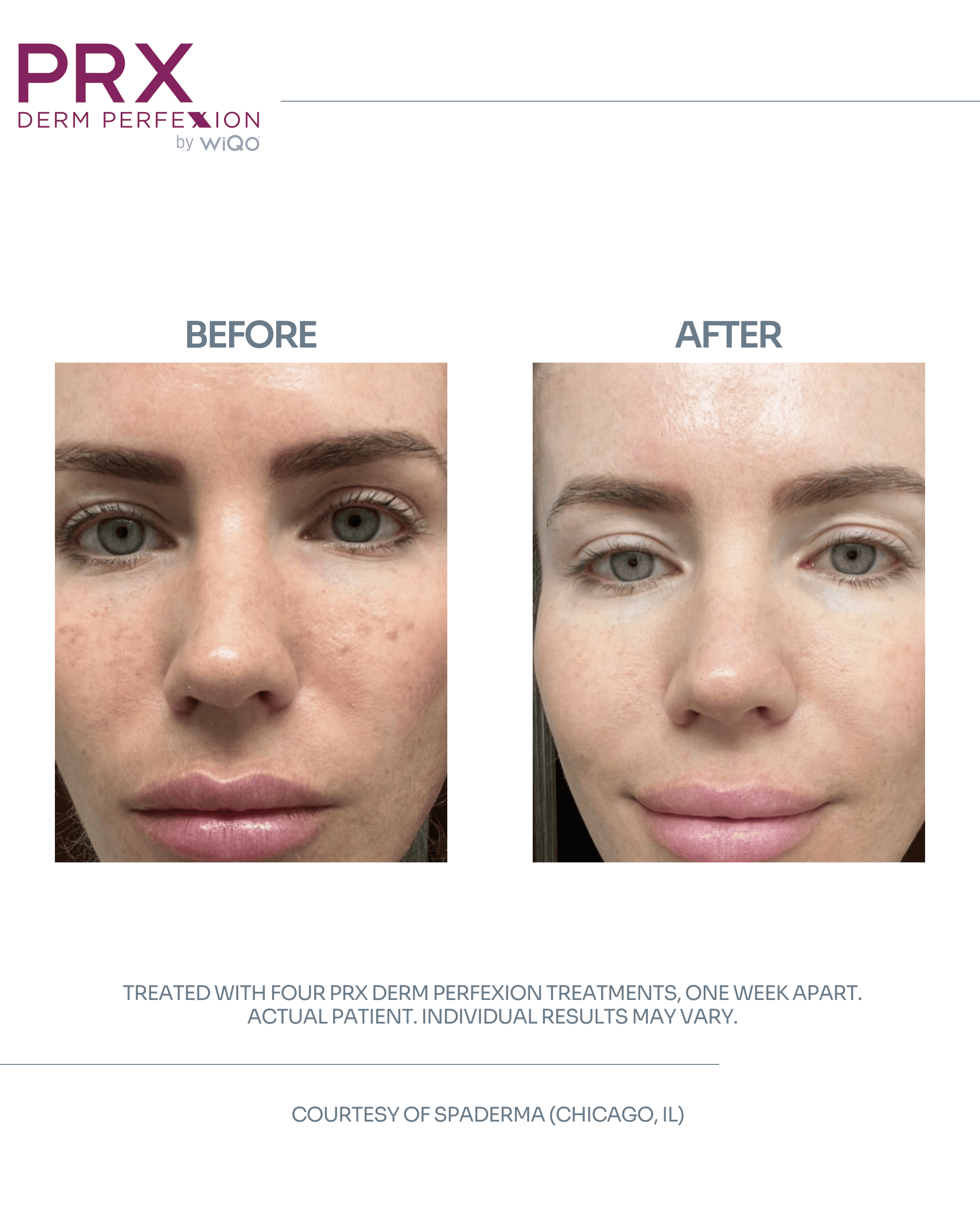 Actual Patient #1 - DETAILS_ 4 PRX Derm Perfexion Treatments (1)