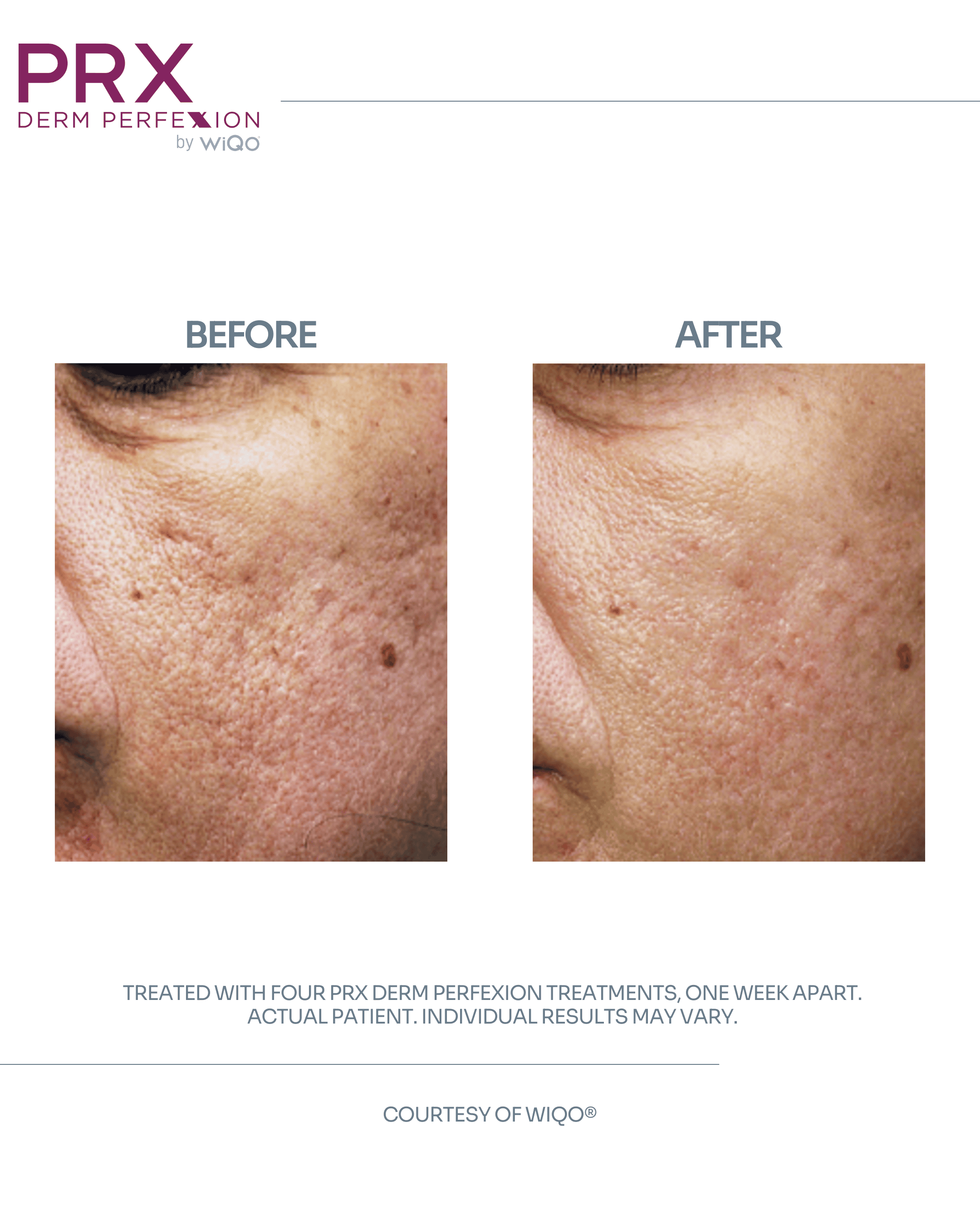 Actual Patient #3 - DETAILS_ 4 PRX Derm Perfexion Treatments