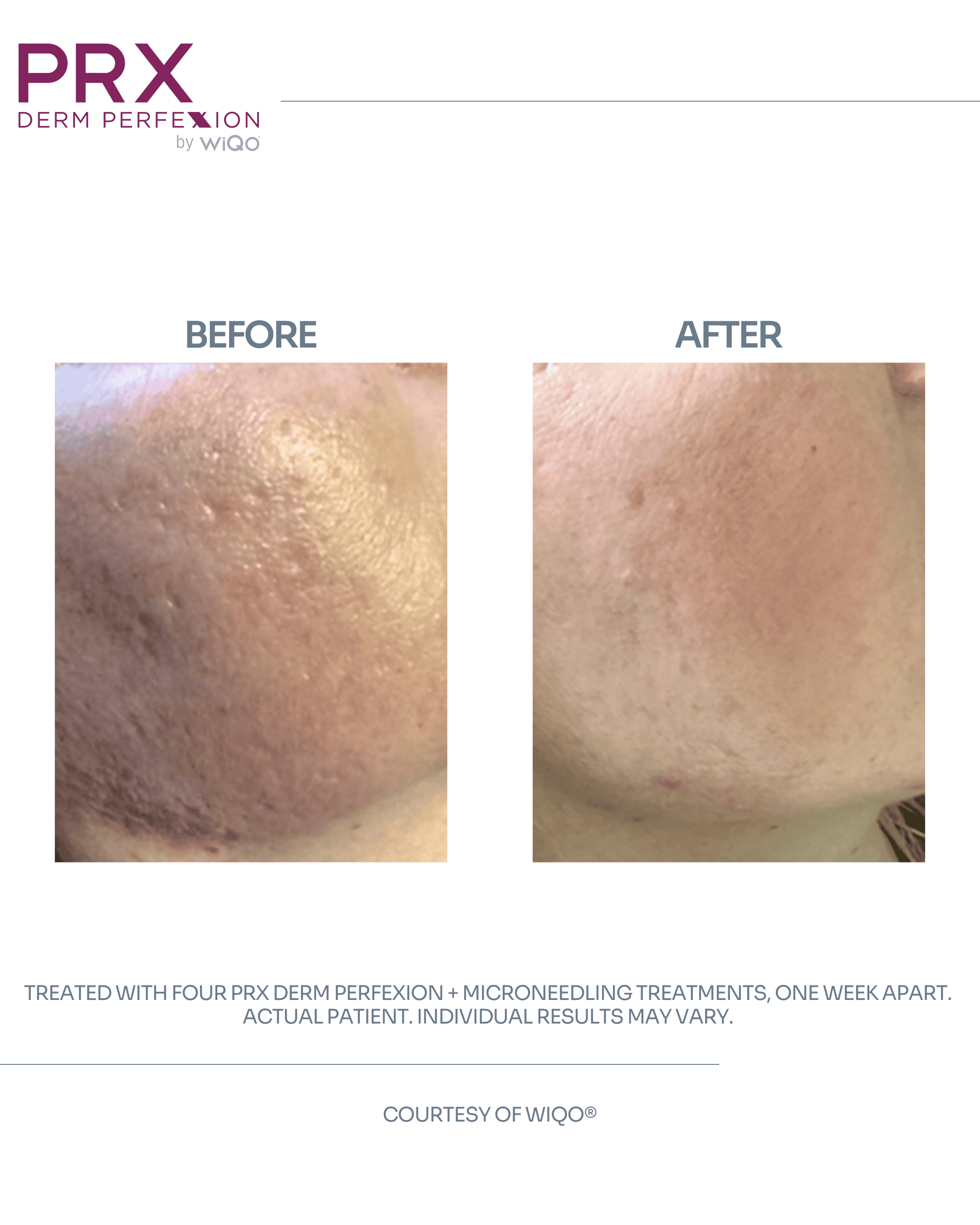 Actual Patient #5 - DETAILS_ 4 PRX Derm Perfexion + Microneedling Treatments