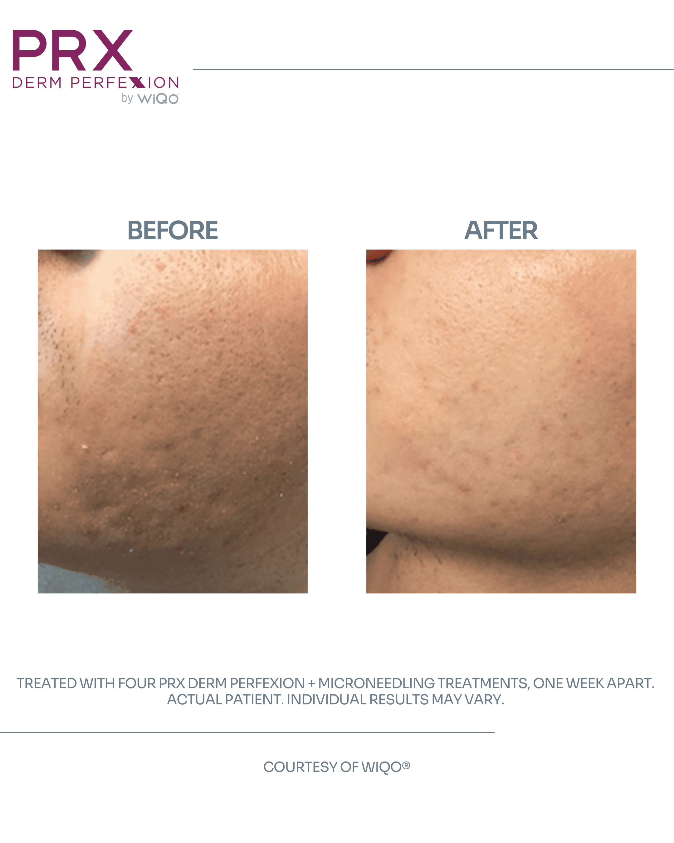 Actual Patient #7 - DETAILS_ 4 PRX Derm Perfexion + Microneedling Treatments